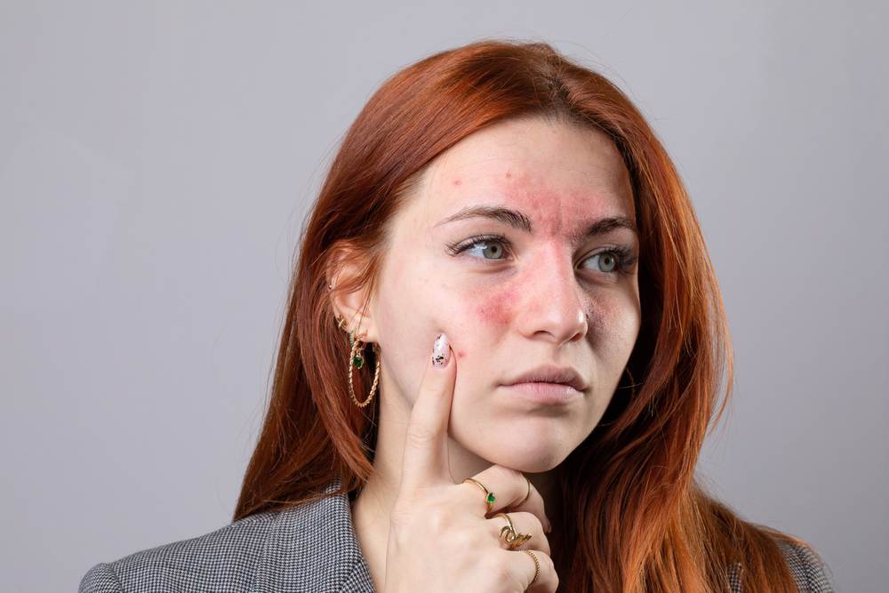 Anche la dermatite può essere un chiaro segnale di manifestazione di pelle secca del viso