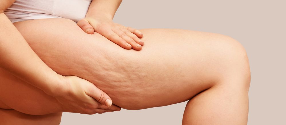 Gamba con problemi di cellulite, quindi pelle a buccia d'arancia