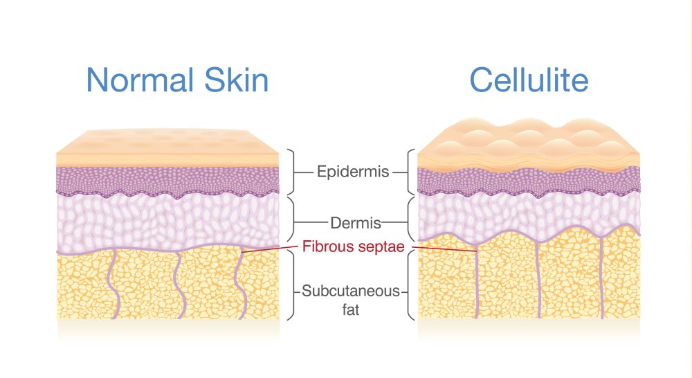 Pelle normale vs cellulite